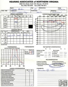 Audiogram, or hearing test profile showing hearing loss levels